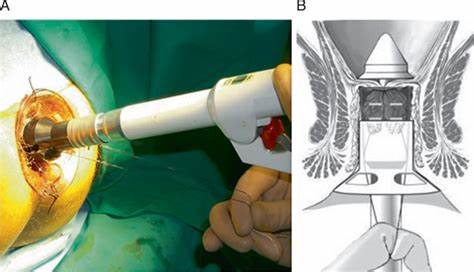 Minimal Invasive Procedures