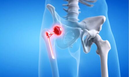 Bilateral Hip Replacement Surgery