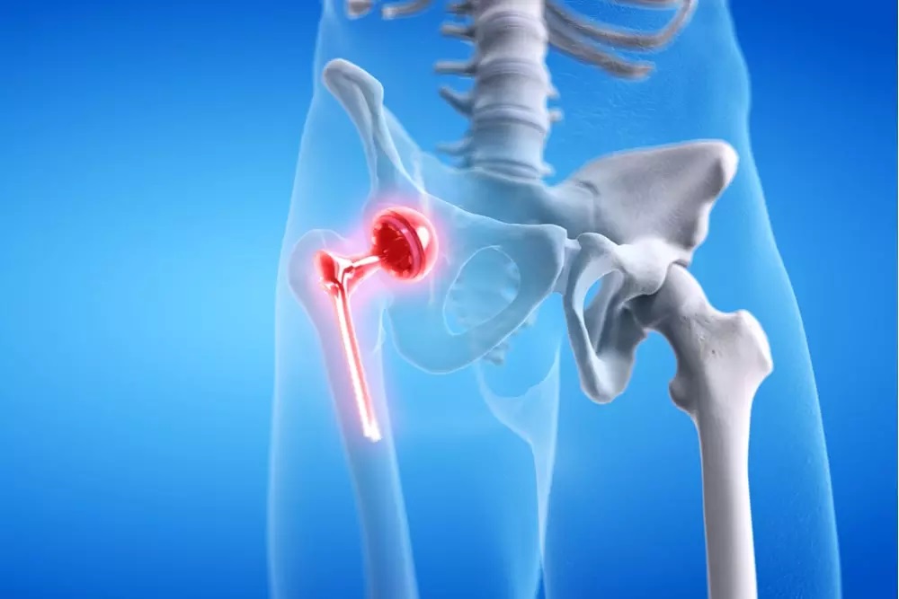 Bilateral Hip Replacement Surgery