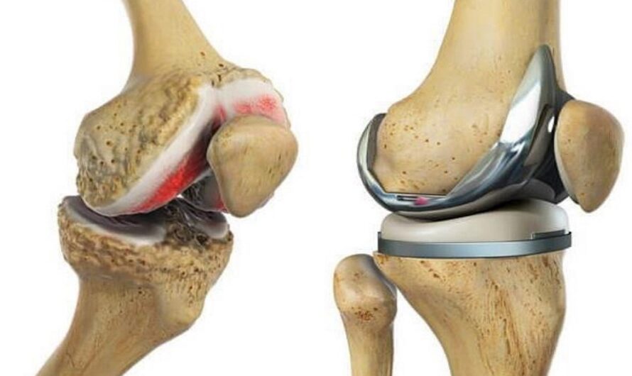 Bilateral/Both Knee Replacement Surgery Cost in India