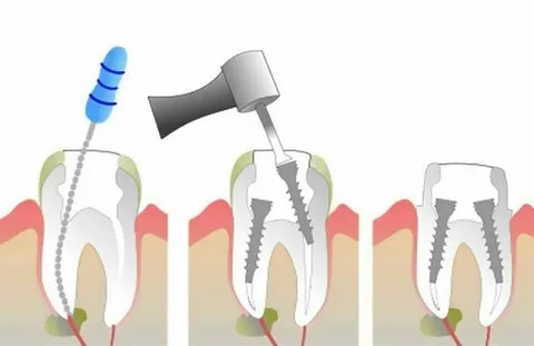  Process of Root Canal Treatment