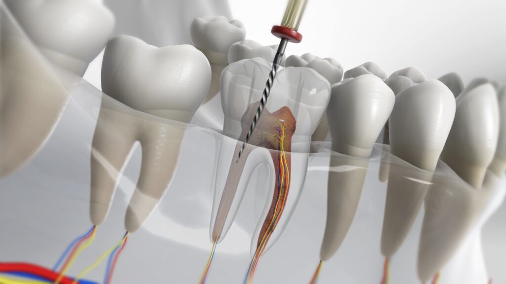 Root Canel Treatment