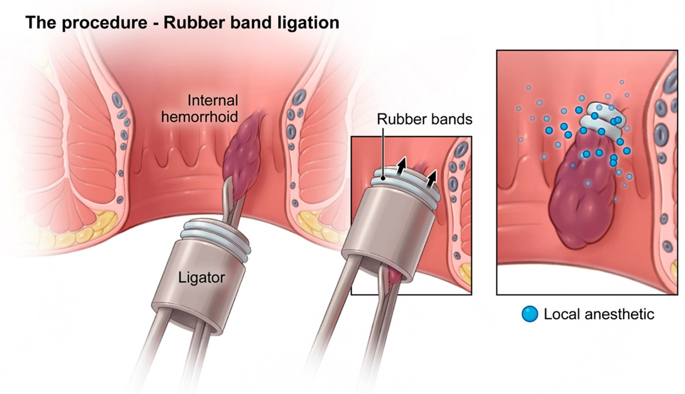 Minimal Invasive Procedures