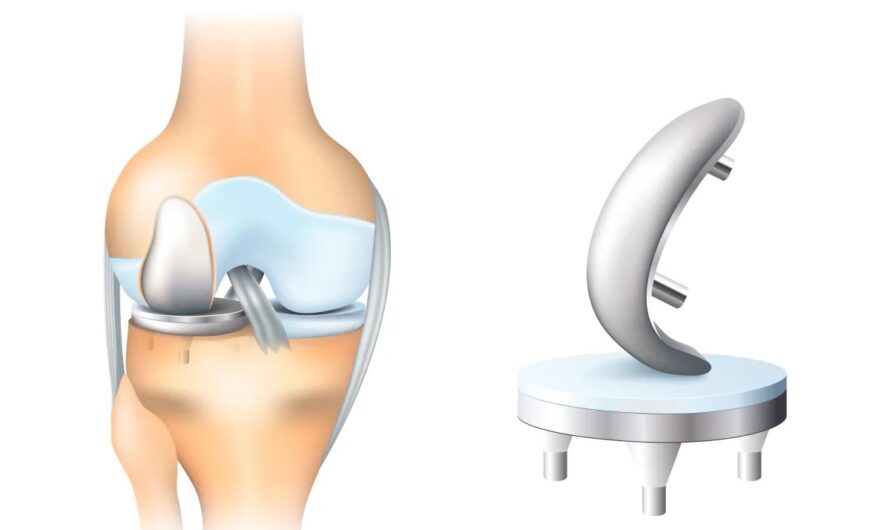 Unilateral Knee Replacement Surgery Cost in India