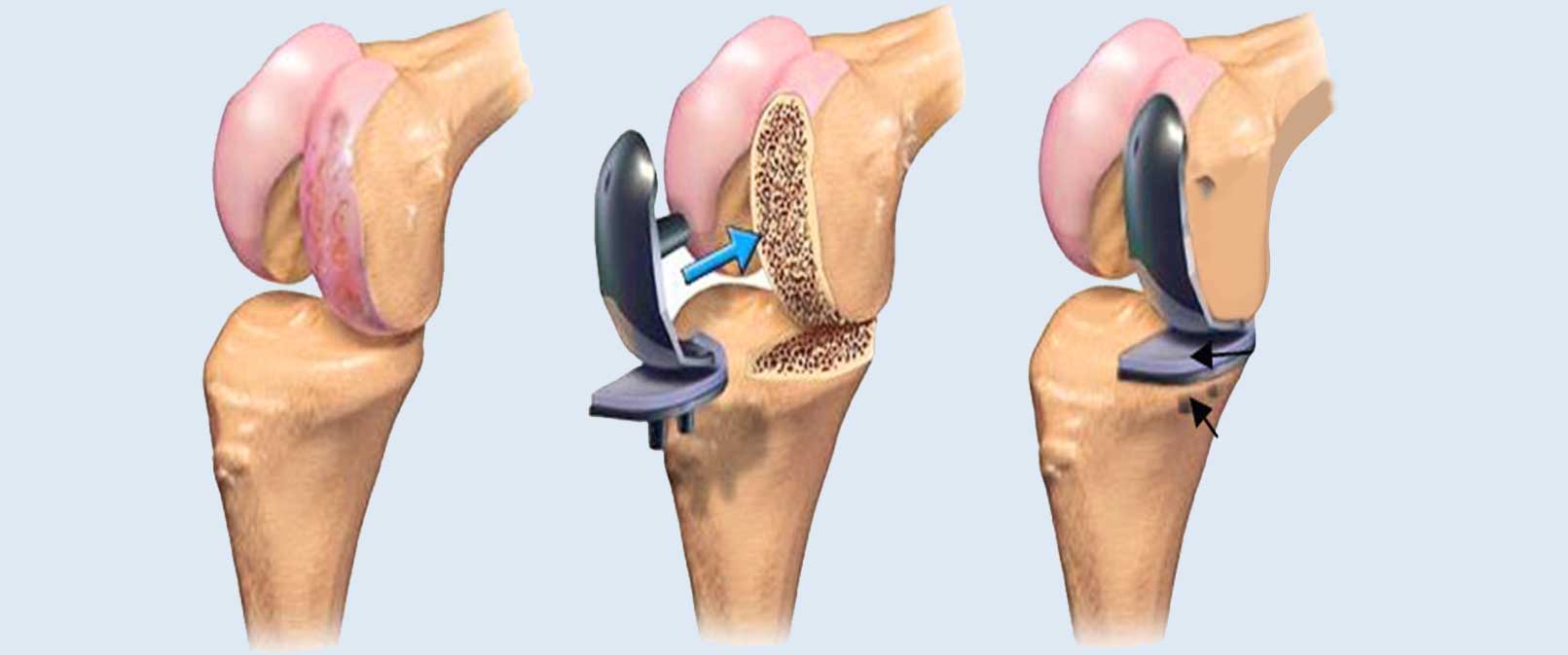 Both Knee Replacement Surgery