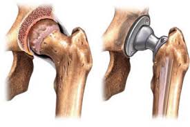 Bilateral Hip Replacement Surgery