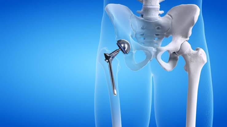 Unilateral Hip Replacement Surgery Cost in India