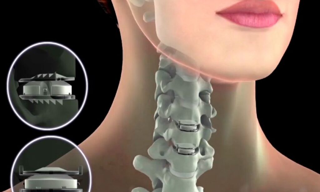 Cervical Disc Replacement Surgery