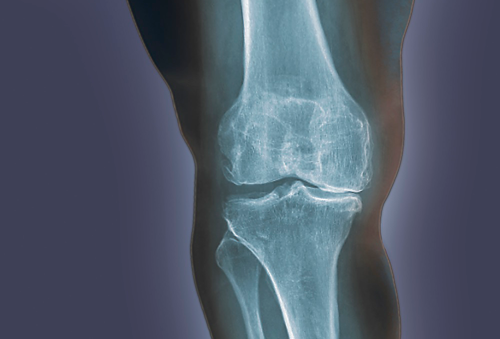 Severe Bilateral Knee Arthritis