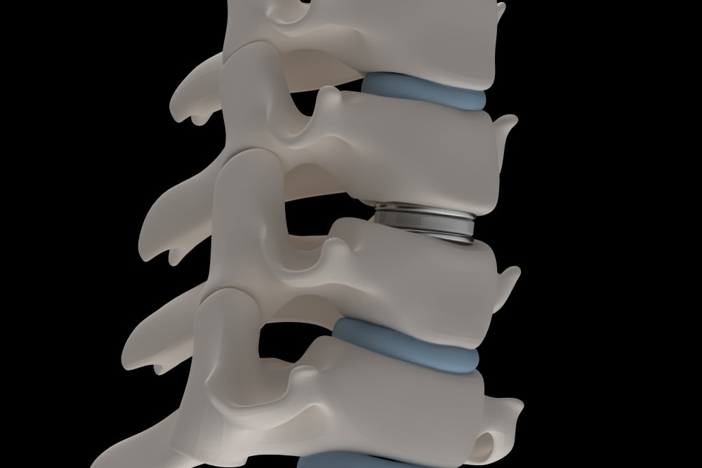 Adjacent Segment Degeneration