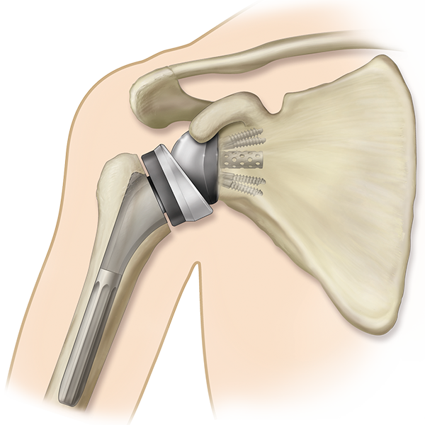 Total Shoulder Replacement 