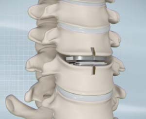 Type of Artificial Disc