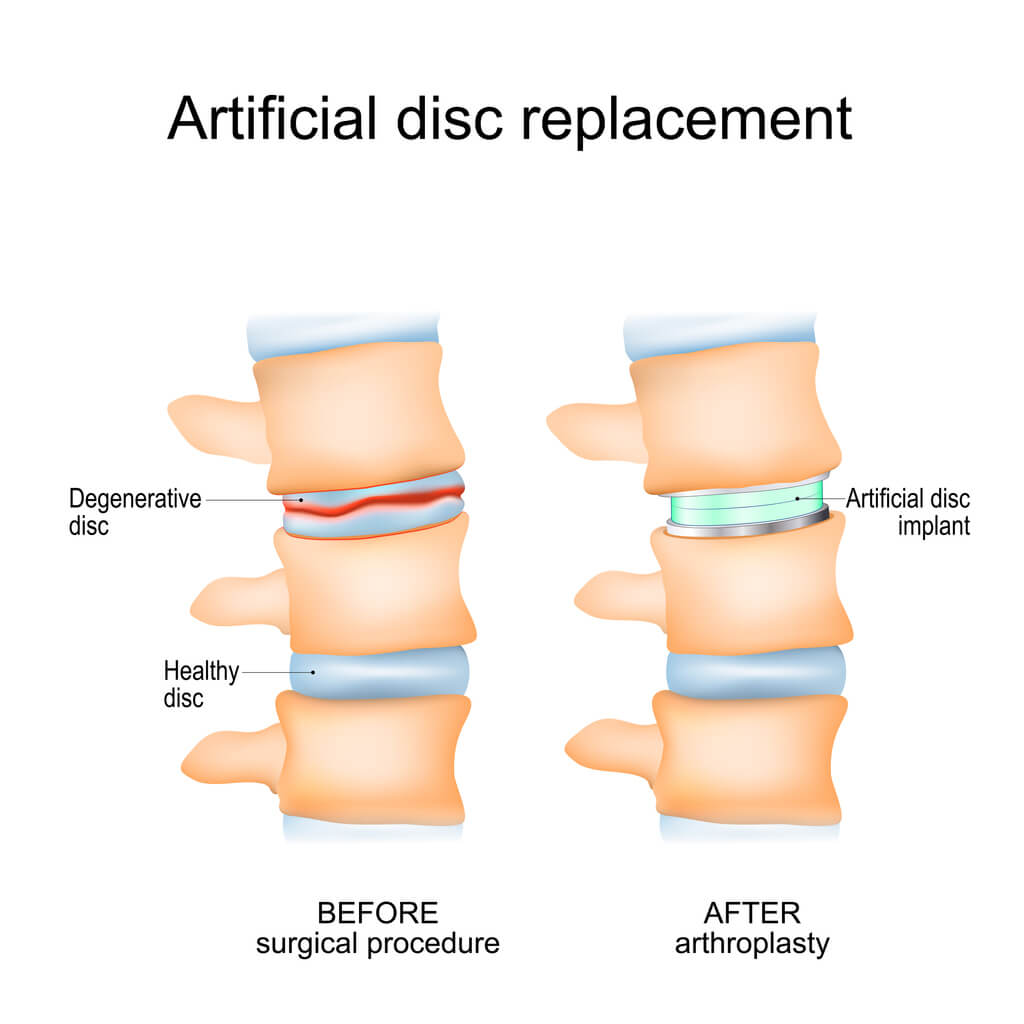 Artificial Disc Replacement
