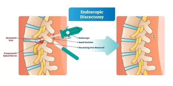 Discectomy