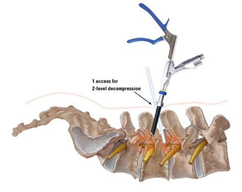 Endoscopic Spine Surgery