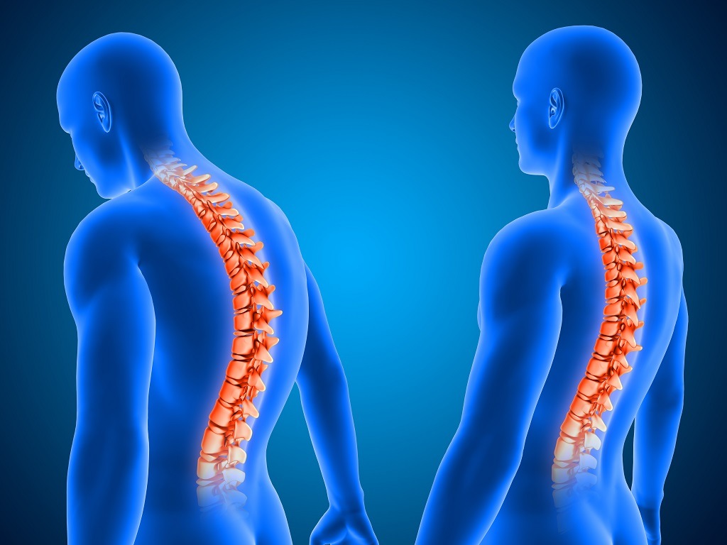 spine surgery myths vs reality